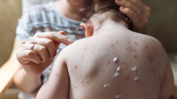 Francia y Alemania confirman sus primeros casos de viruela del mono