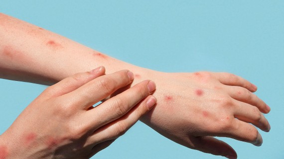 Monkeypox | Marina Demidiuk